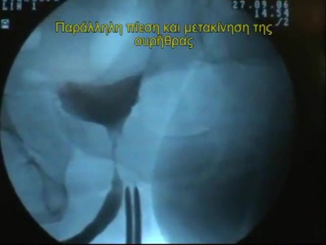 Male Sling Procedure For Urinary Incontinence