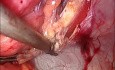 IPOM Plus Hernioplasty