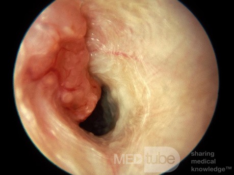 Adenocarcinoma Invading External Auditory Canal