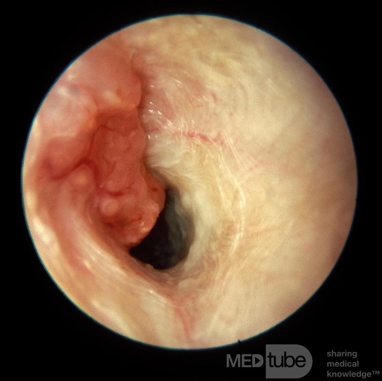 Adenocarcinoma Invading External Auditory Canal