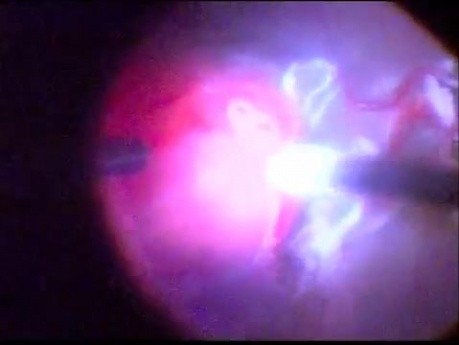 Vascular tumor of retina management