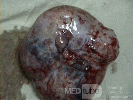 Arrhenoblastoma