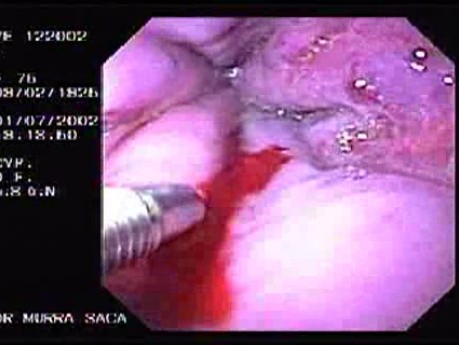 Hemorrhage Due Status Post Rubber Band Ligation of Esophageal Varices - Injection of Polydocanol