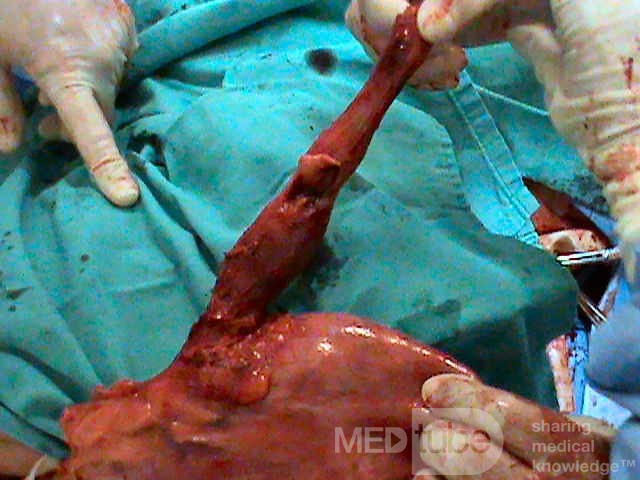 Barrett Adenocarcinoma - Endoscopic Image (14 of 20)