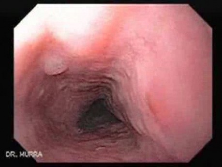 Cytomegalovirus Esophagitis - Assessment of the Mucosa