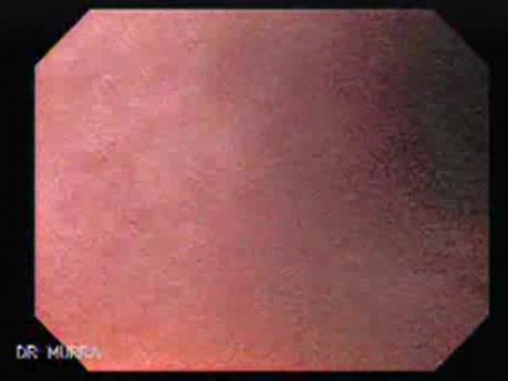 Pill Esophagitis - 2/5
