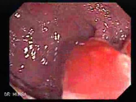 Multiple Adenomatous Polyps Of The Rectum (1 of 37)