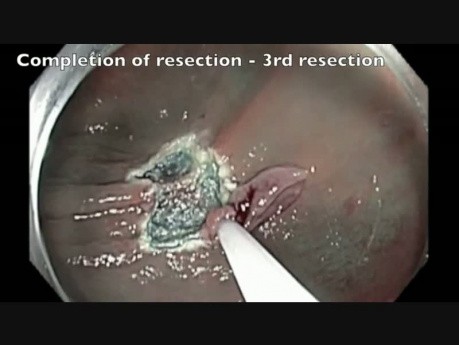 Colon EMR Perforation Analysis-G