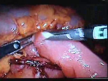 Jejunal Gastrointestinal Stromal tumor (GIST) (38 of 86)