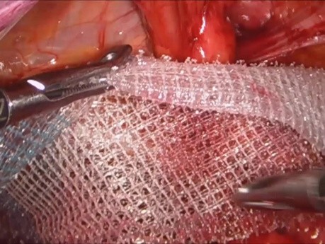 Different Mesh Types in Laparoscopic TAPP of Inguinal Hernia Repair
