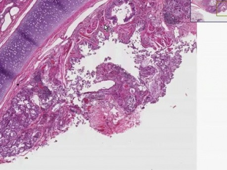 Asthma - Histopathology - Lung, lymph node