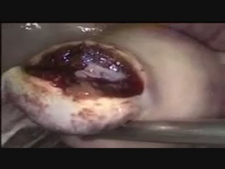 Cornual Ectopic Pregnancy