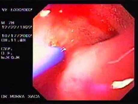 Duodenal Ulcer and Bleeding (3 of 4)