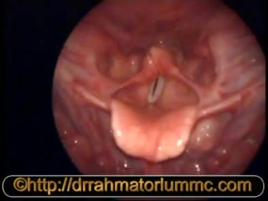 Use of 70 Degrees Endoscope - Surface Marking of Thyroid Cartilage