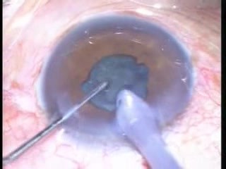 Phacoemulsification - Small Pupil