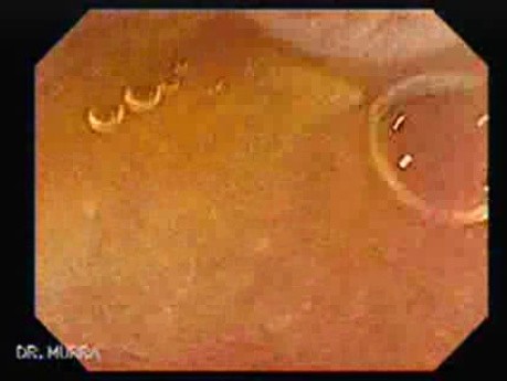 Schistosoma Mansoni in the Cecum (4 of 9)