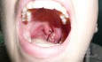 Amigdalitis Tonsillitis