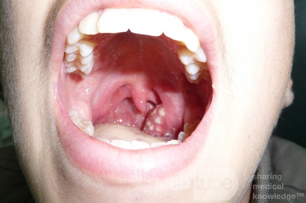 Do You Have an Abscessed Tooth? - WebMD