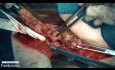 Uterine Fundectomy