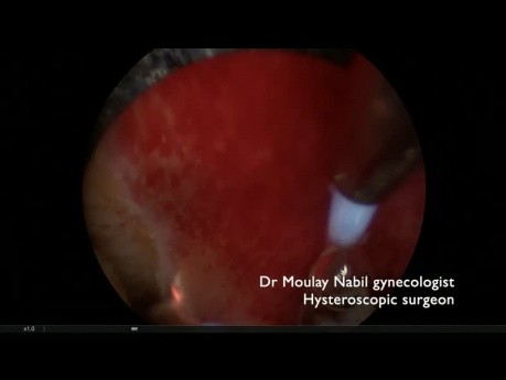 Classical Endometrial and Polyp Resection