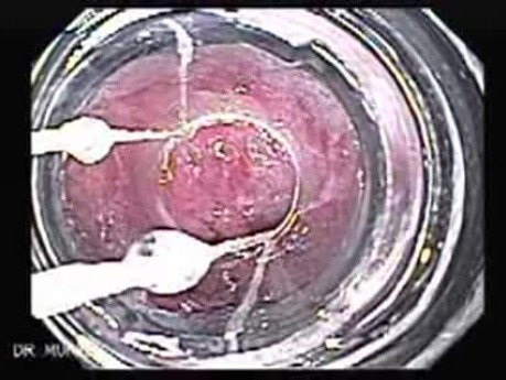 Esophageal Variceal Bleeding - Accurate Presentation of Ligation