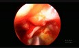 Synechiae after Radiotherapy for an Undifferentiated Nasopharyngeal Carcinoma