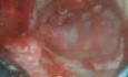 Revision Mastoidectomy Part 4: Fascia Grafting, Ossiculop