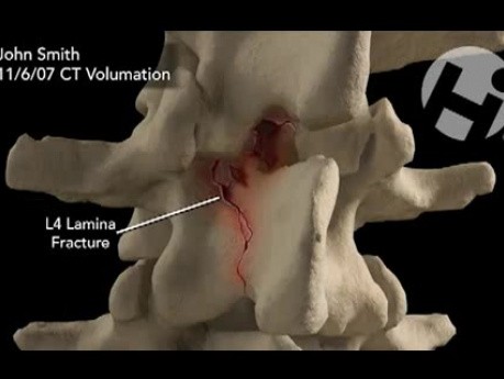 Pre-Op and Post-Op Volumations of the Lumbar Spine