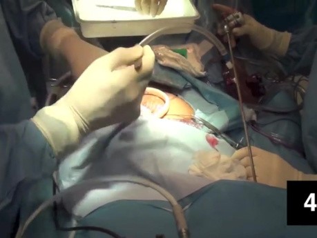 Morcellation of uterus in 10 minutes