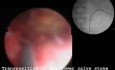 Stone In The Lower Calyx - Nephrolithotripsy