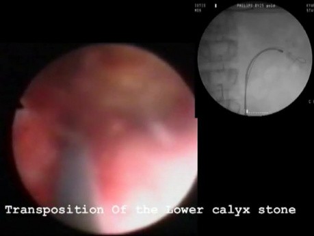 Stone In The Lower Calyx - Nephrolithotripsy