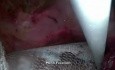 Incisional Hernioplasty - SILS