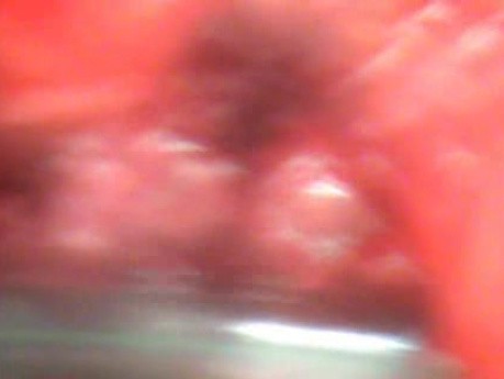 Perforation of a Esophageal Carcinoma After the Procedure with Hydrostatic Balloon Dilation - Suction Before the Surgery