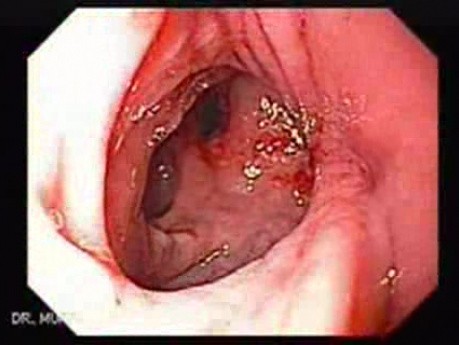 Colonic Interposition for Esophageal Substitution (10 of 11)