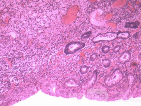 Multiple Rectal Ulcers (107 of 110)