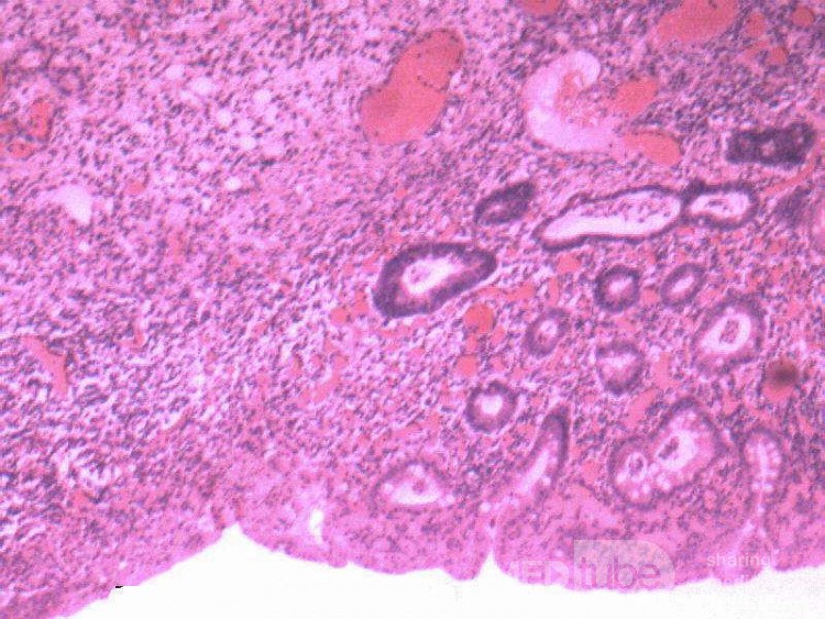 Multiple Rectal Ulcers (107 of 110)