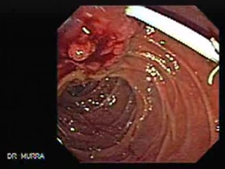 Adenocarcinoma of Papilla of Vater (5 of 5)