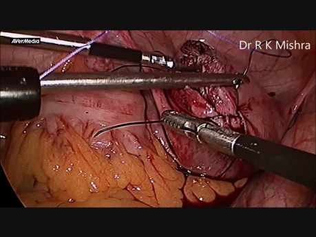 Laparoscopic Myomectomy