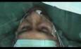 Awake Aortic Valve Replacement (AVR) - Thoracic Epidural Anaesthesia