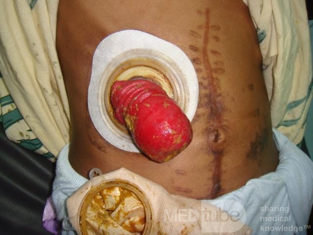 Prolapsed temporary colostomy 