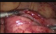 Large Ovarian Cyst.