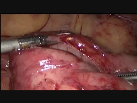 Large Ovarian Cyst.