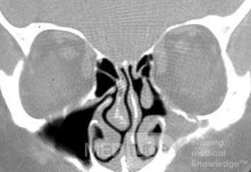 Fungal sinusitis [CT scan]