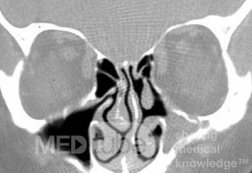 Fungal sinusitis [CT scan]