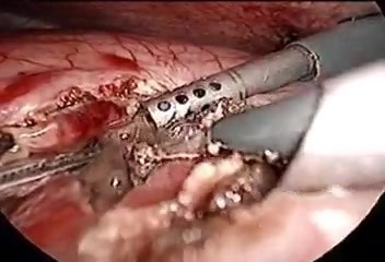 Cystogastrostomy - pancreatic pseudocyst