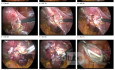 Ectopic Pregnancy Frames for Surgery - Clinical Pearls No. 1