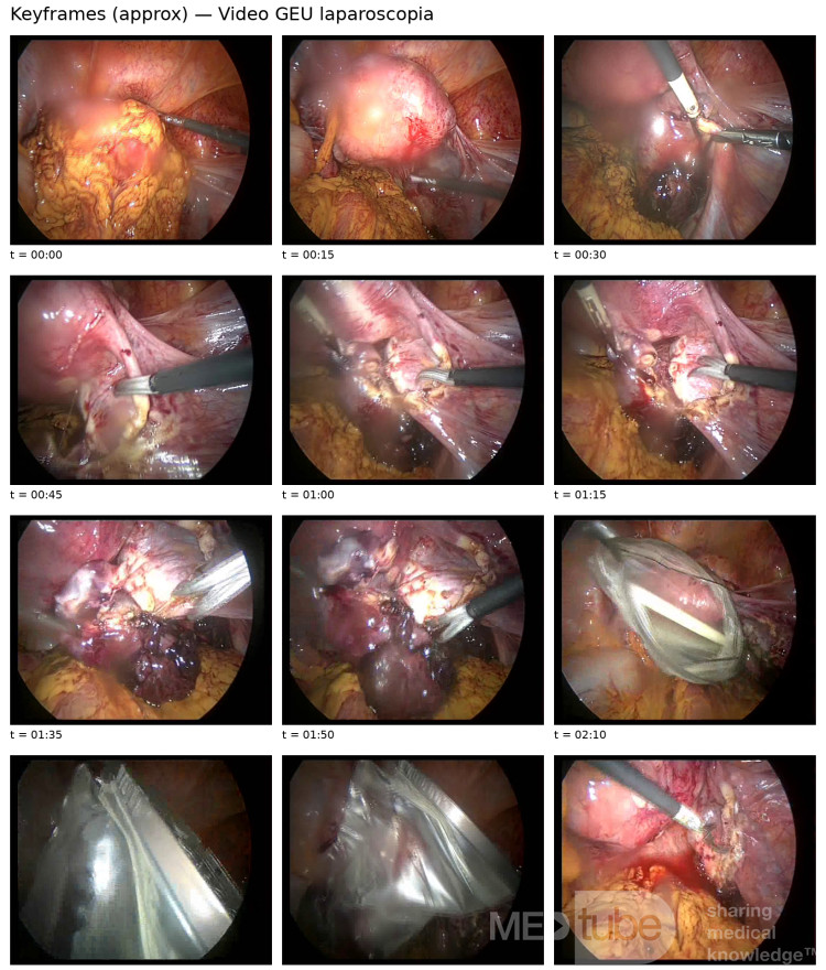 Ectopic Pregnancy Frames for Surgery - Clinical Pearls No. 1
