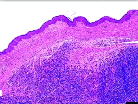 Tasmanian Devil Facial tumor (DFTD)