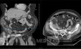 Amyand Hernia Appendicitis