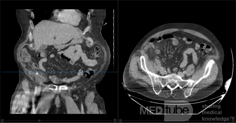 Amyand Hernia Appendicitis